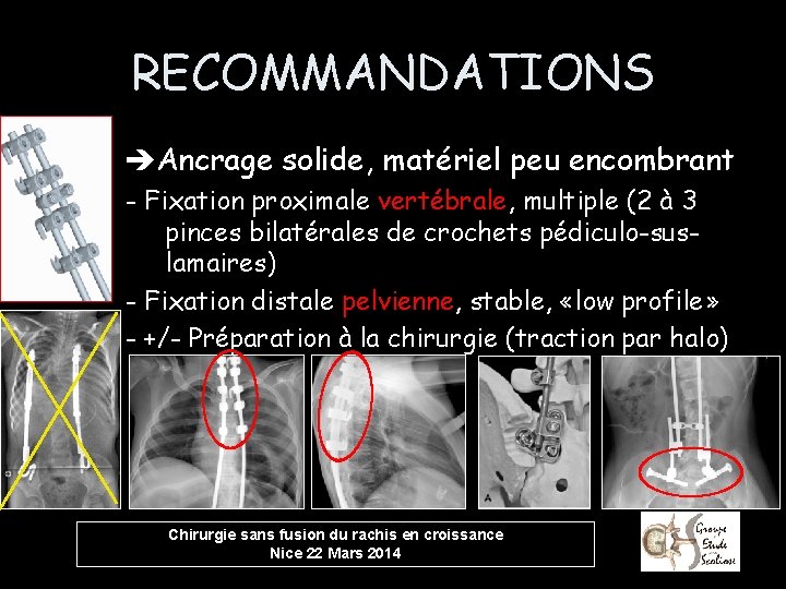 RECOMMANDATIONS Ancrage solide, matériel peu encombrant - Fixation proximale vertébrale, multiple (2 à 3