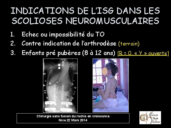 INDICATIONS DE L’ISG DANS LES SCOLIOSES NEUROMUSCULAIRES 1. Echec ou impossibilité du TO 2.