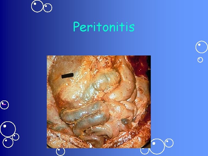 Peritonitis 