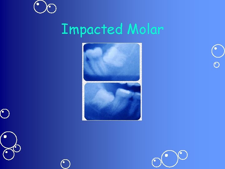 Impacted Molar 