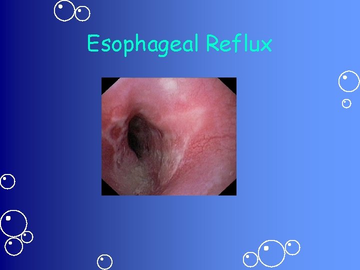 Esophageal Reflux 