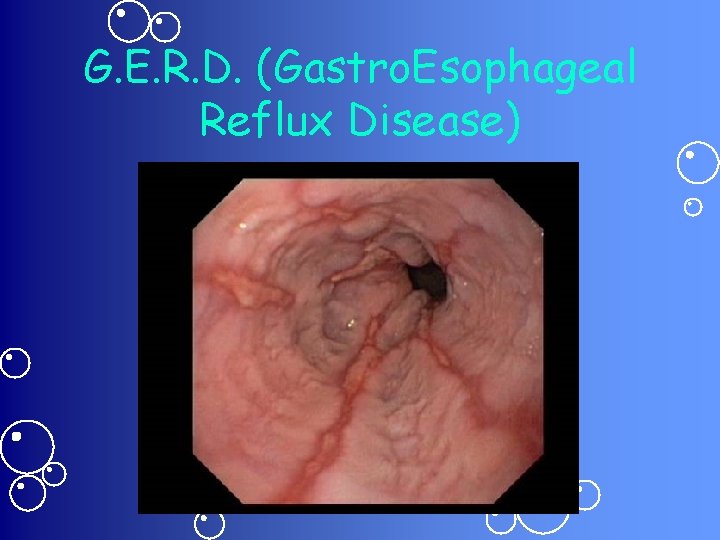 G. E. R. D. (Gastro. Esophageal Reflux Disease) 