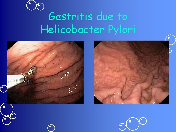 Gastritis due to Helicobacter Pylori 
