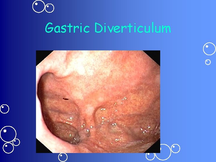 Gastric Diverticulum 