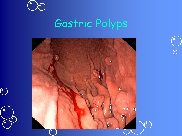 Gastric Polyps 