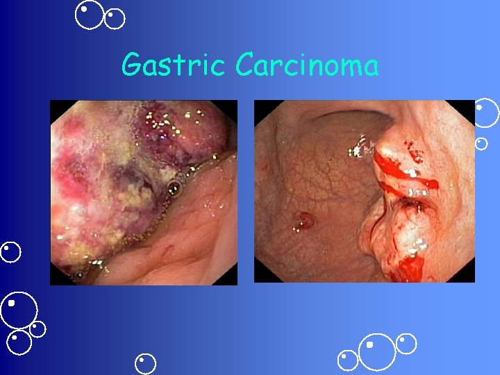 Gastric Carcinoma 