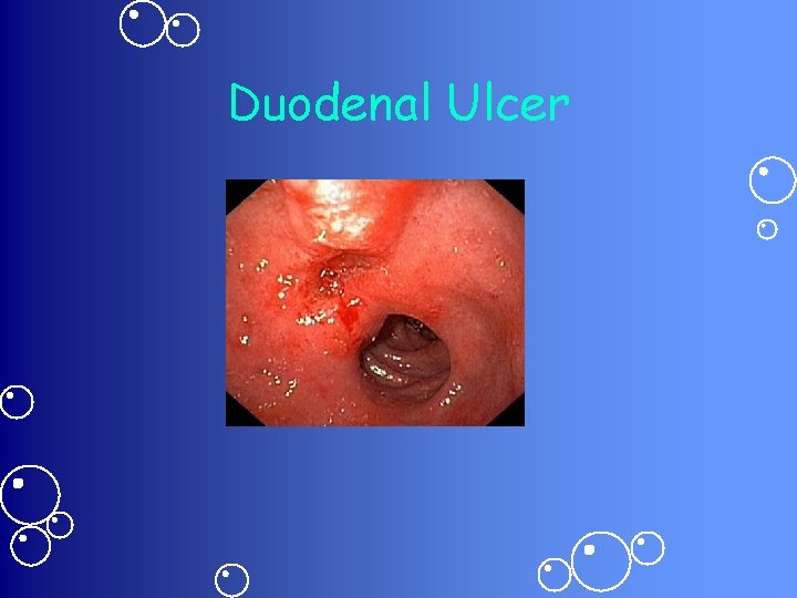 Duodenal Ulcer 
