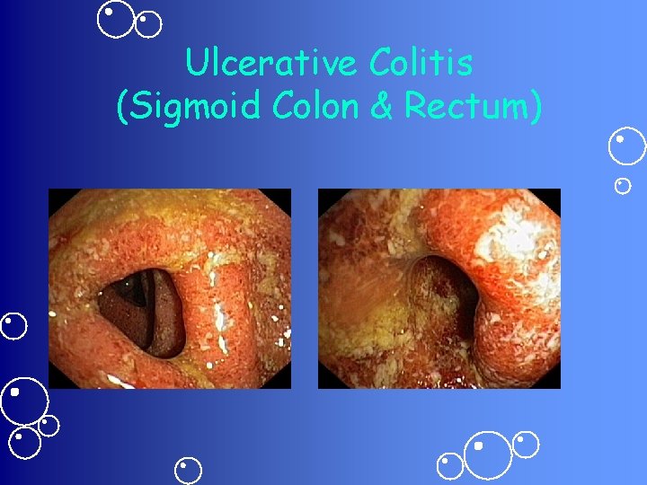Ulcerative Colitis (Sigmoid Colon & Rectum) 