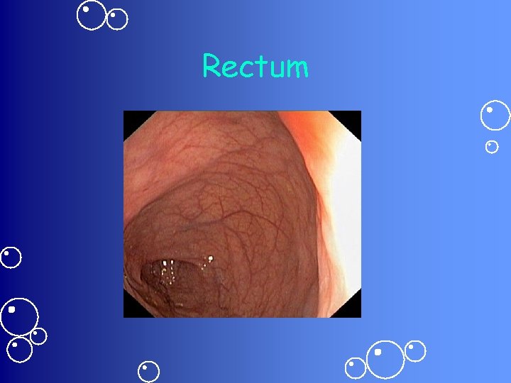 Rectum 