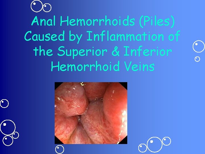 Anal Hemorrhoids (Piles) Caused by Inflammation of the Superior & Inferior Hemorrhoid Veins 
