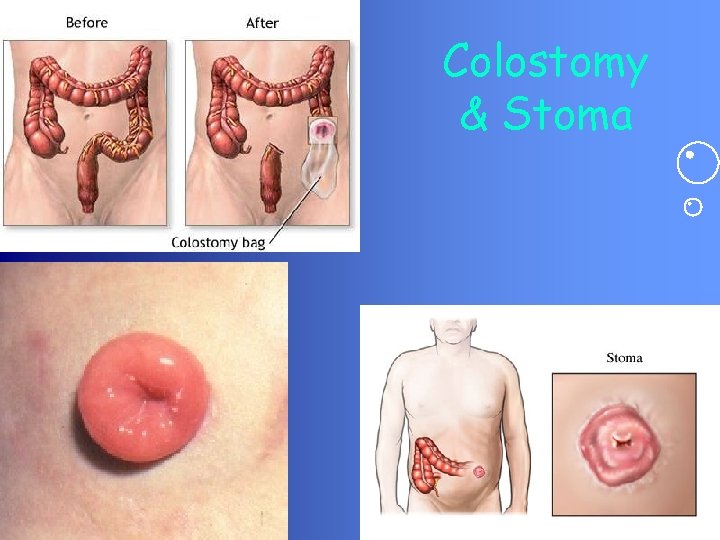 Colostomy & Stoma 