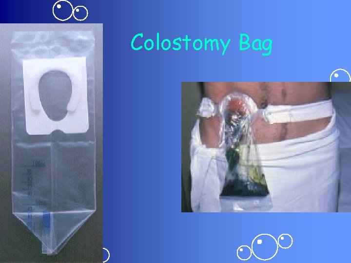 Colostomy Bag 