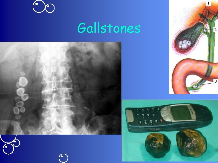 Gallstones 