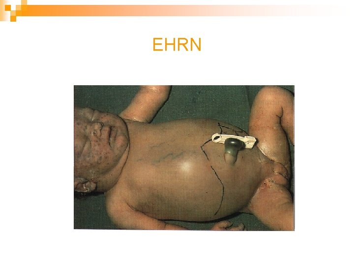 EHRN 