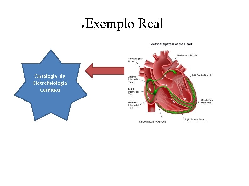 ● Ontologia de Eletrofisiologia Cardíaca Exemplo Real 