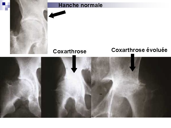 Hanche normale Coxarthrose évoluée 