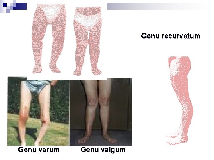 Genu recurvatum Genu varum Genu valgum 