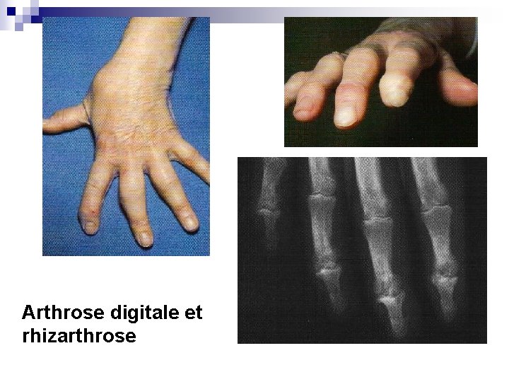 Arthrose digitale et rhizarthrose 