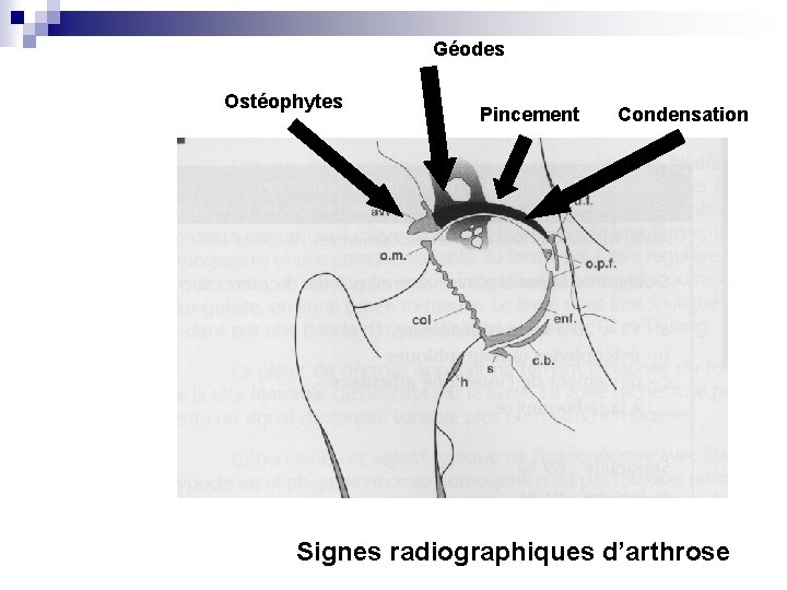 Géodes Ostéophytes Pincement Condensation Signes radiographiques d’arthrose 