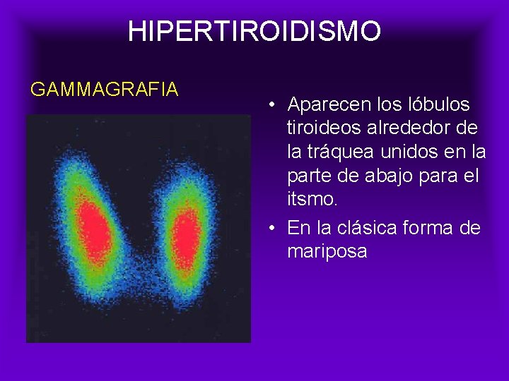 HIPERTIROIDISMO GAMMAGRAFIA • Aparecen los lóbulos tiroideos alrededor de la tráquea unidos en la