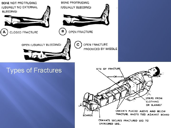 Types of Fractures Types of Fractures