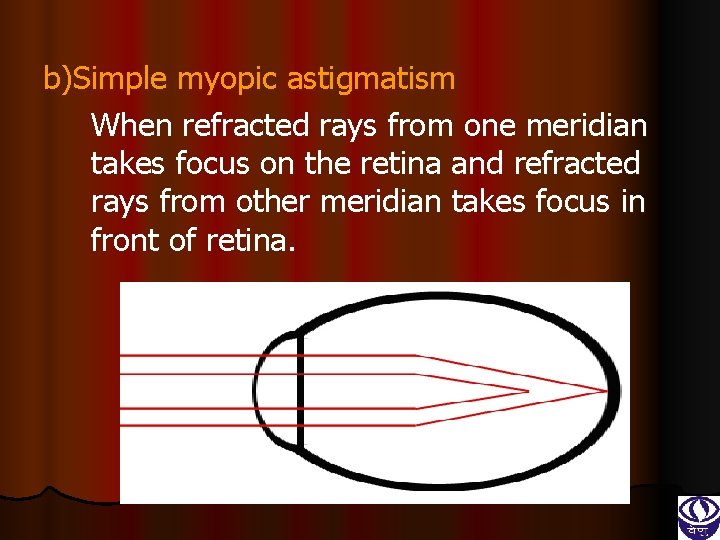 b)Simple myopic astigmatism When refracted rays from one meridian takes focus on the retina