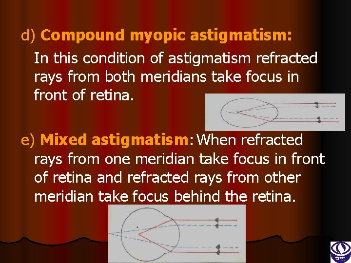 d) Compound myopic astigmatism: In this condition of astigmatism refracted rays from both meridians