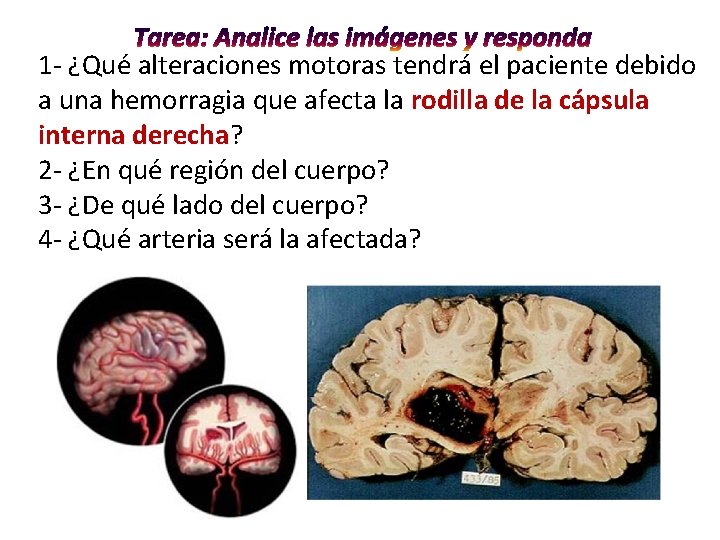1 - ¿Qué alteraciones motoras tendrá el paciente debido a una hemorragia que afecta 1 - ¿Qué alteraciones motoras tendrá el paciente debido a una hemorragia que afecta
