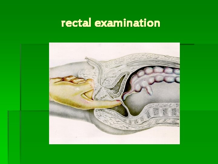rectal examination 