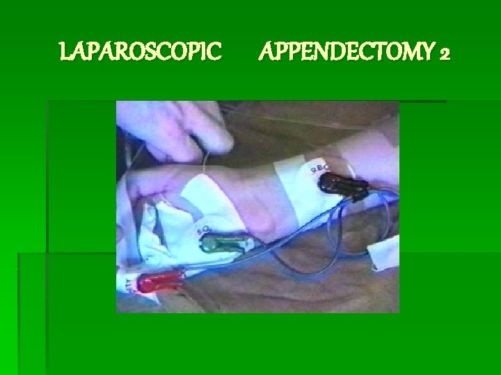 LAPAROSCOPIC APPENDECTOMY 2 