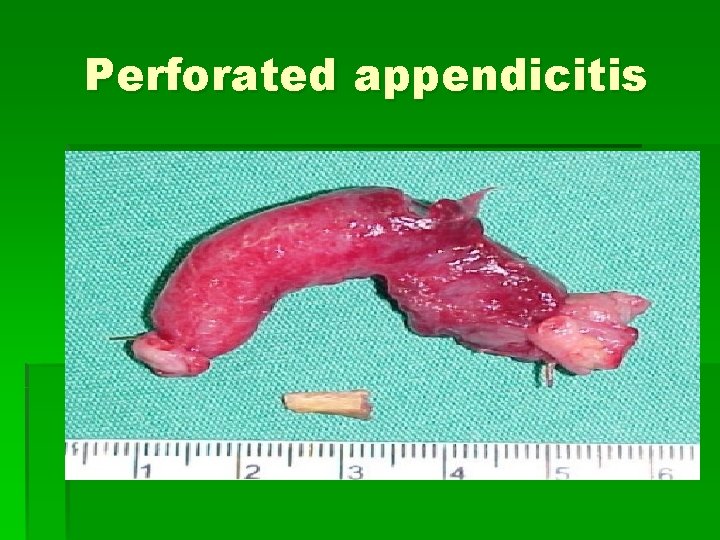 Perforated appendicitis 
