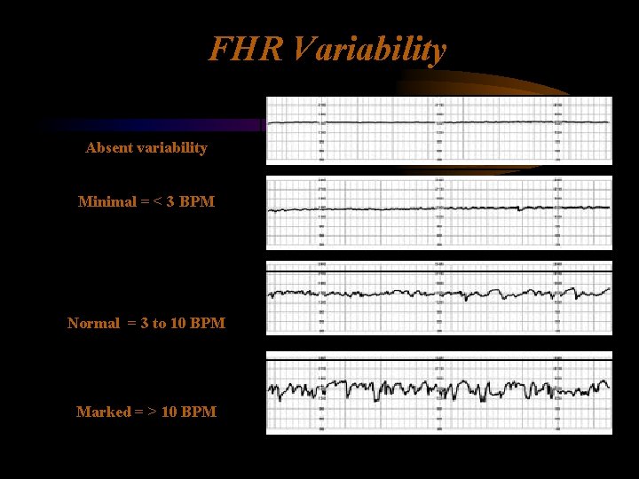 FHR Variability Absent variability Minimal = < 3 BPM Normal = 3 to 10