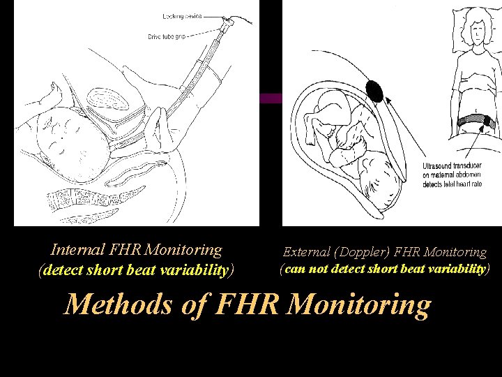 Internal FHR Monitoring (detect short beat variability) External (Doppler) FHR Monitoring (can not detect