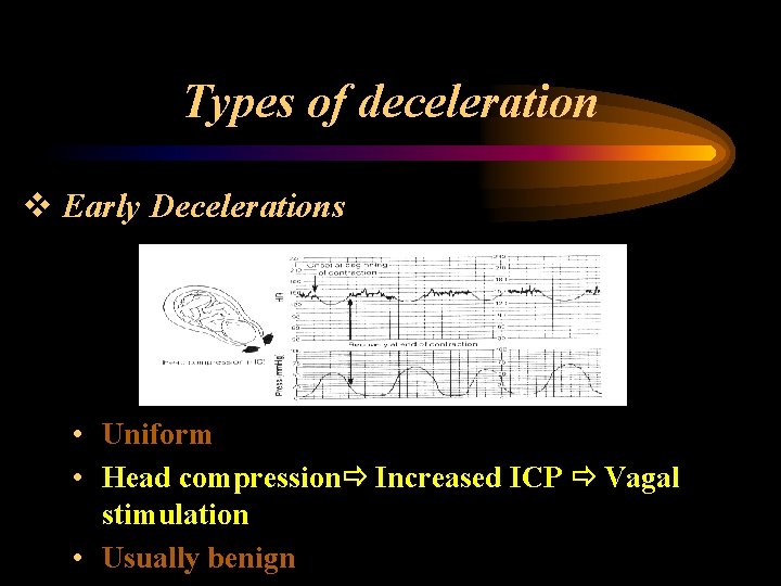 Types of deceleration v Early Decelerations • Uniform • Head compression Increased ICP Vagal