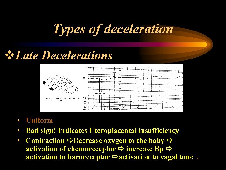 Types of deceleration v. Late Decelerations • Uniform • Bad sign! Indicates Uteroplacental insufficiency