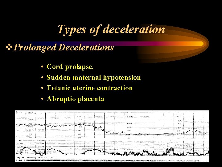 Types of deceleration v. Prolonged Decelerations • • Cord prolapse. Sudden maternal hypotension Tetanic