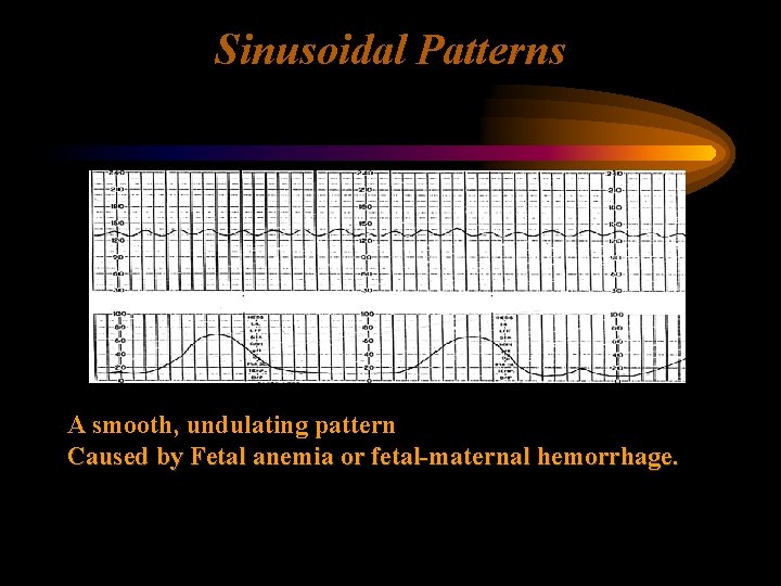 Sinusoidal Patterns A smooth, undulating pattern Caused by Fetal anemia or fetal-maternal hemorrhage. 
