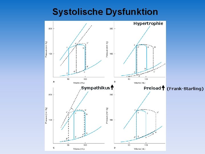 Systolische Dysfunktion Hypertrophie Sympathikus Preload (Frank-Starling) Systolische Dysfunktion Hypertrophie Sympathikus Preload (Frank-Starling)