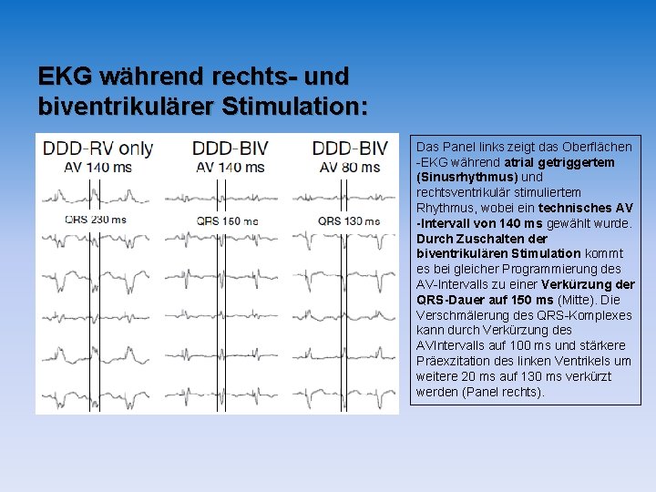 EKG während rechts- und biventrikulärer Stimulation: Das Panel links zeigt das Oberflächen -EKG während EKG während rechts- und biventrikulärer Stimulation: Das Panel links zeigt das Oberflächen -EKG während