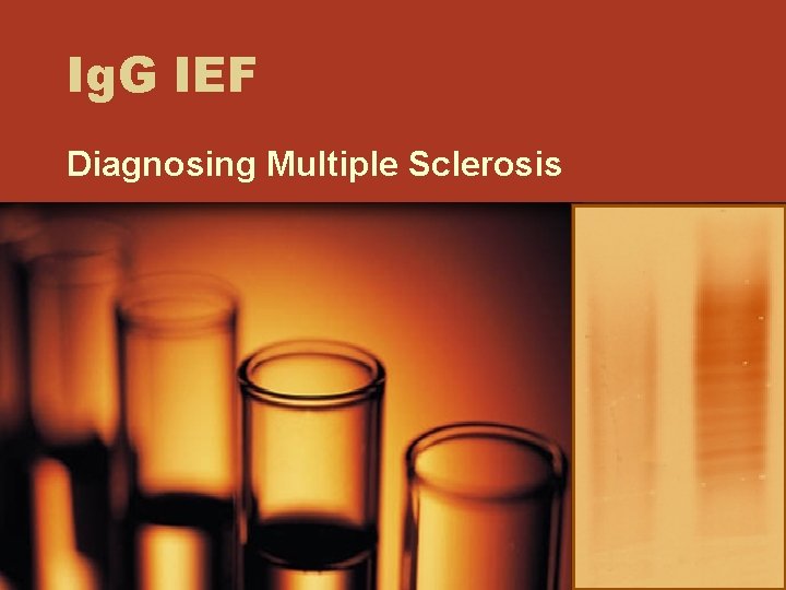 Ig. G IEF Diagnosing Multiple Sclerosis 