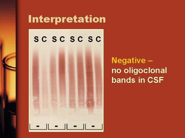 Interpretation Negative – no oligoclonal bands in CSF 