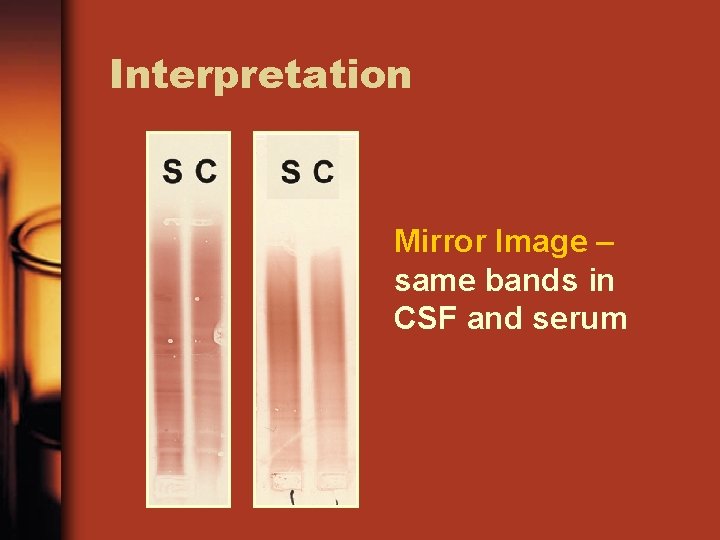Interpretation Mirror Image – same bands in CSF and serum 