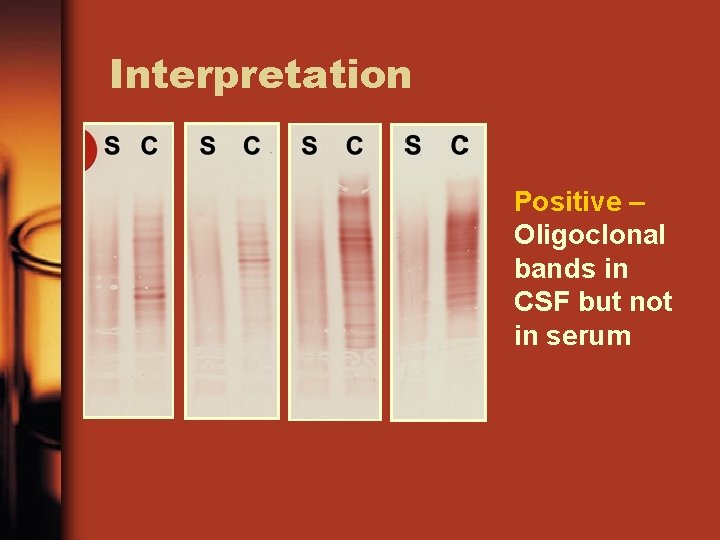 Interpretation Positive – Oligoclonal bands in CSF but not in serum 