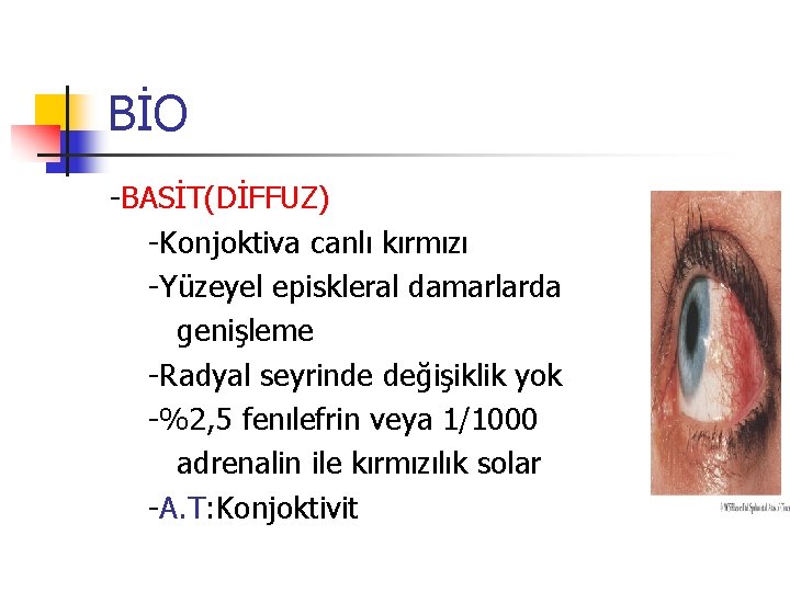 BİO -BASİT(DİFFUZ) -Konjoktiva canlı kırmızı -Yüzeyel episkleral damarlarda genişleme -Radyal seyrinde değişiklik yok -%2,