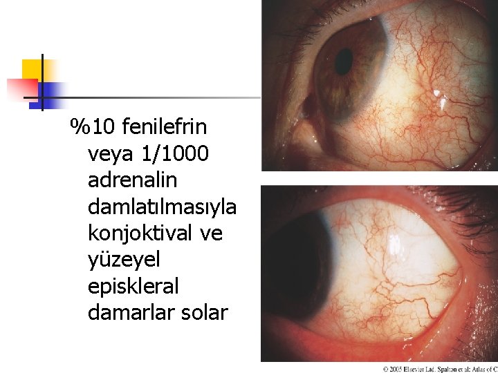 %10 fenilefrin veya 1/1000 adrenalin damlatılmasıyla konjoktival ve yüzeyel episkleral damarlar solar 