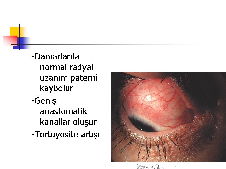 -Damarlarda normal radyal uzanım paterni kaybolur -Geniş anastomatik kanallar oluşur -Tortuyosite artışı 