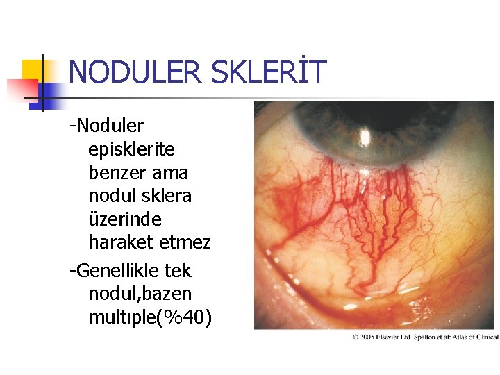 NODULER SKLERİT -Noduler episklerite benzer ama nodul sklera üzerinde haraket etmez -Genellikle tek nodul,