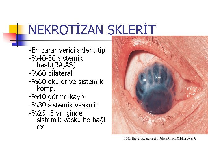 NEKROTİZAN SKLERİT -En zarar verici sklerit tipi -%40 -50 sistemik hast. (RA, AS) -%60