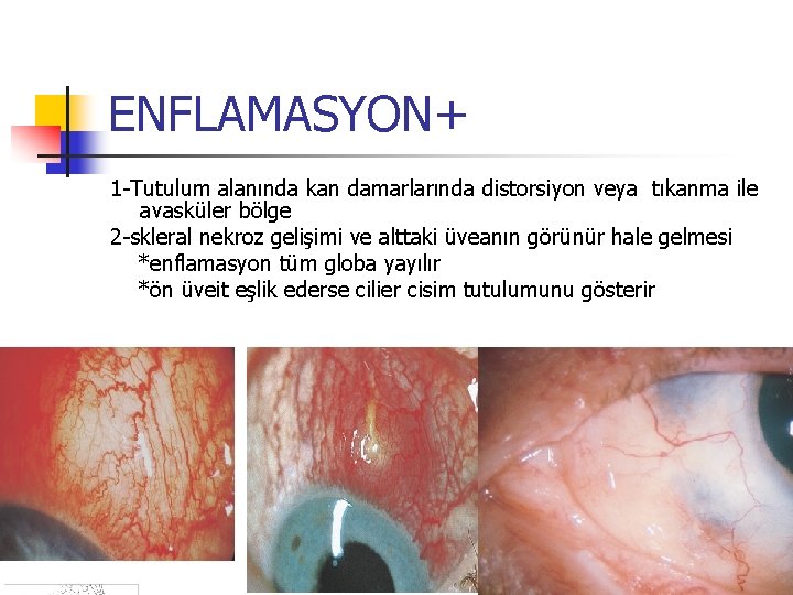 ENFLAMASYON+ 1 -Tutulum alanında kan damarlarında distorsiyon veya tıkanma ile avasküler bölge 2 -skleral