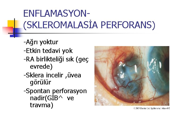 ENFLAMASYON(SKLEROMALASİA PERFORANS) -Ağrı yoktur -Etkin tedavi yok -RA birlikteliği sık (geç evrede) -Sklera incelir